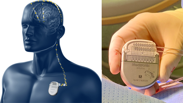 Neurostimulator evaluations